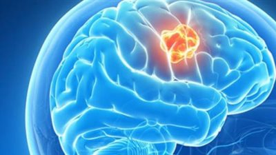 طبيب يكشف لـ«هير نيوز»: أمراض المخ والأعصاب الأكثر انتشاراً بين السيدات  