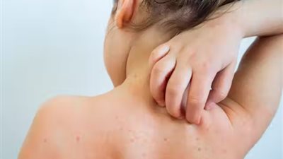 نصائح مهمة للتعامل مع إصابة طفلك بالجدري المائي