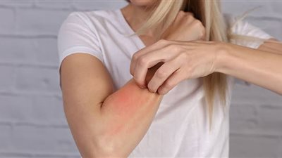 مع دخول الصيف.. أعراض الحساسية لسم الحشرات وطرق العلاج 