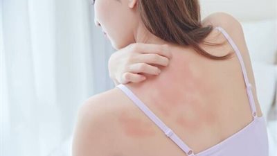 لمشاكل الحكة.. 7 علاجات منزلية لتهدئة بشرتك خلال فصل الصيف