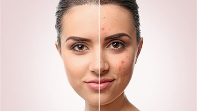  قبل عيد الأضحى .. ماسكات طبيعية ساحرة للتخلص من حب الشباب 