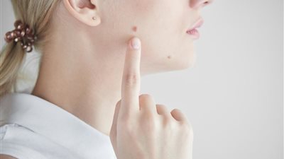 خلطات طبيعية فعالة للتخلص من الشامات البارزة في الوجة