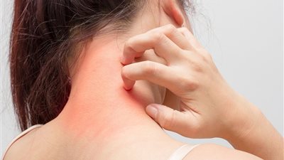 خلطات طبيعية للعناية بالبشرة المصابة بالأكزيما في الصيف