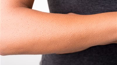 وصفات طبيعية فعالة لعلاج جلد الوزة