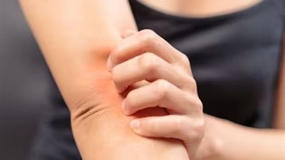 لو اتحرقتي وانتي بتعملي الأكل.. أفضل 5 علاجات طبيعية لحروق الجلد