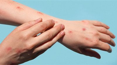 هل يشكل جدري القرود خطورة على مصر.. وما هي الأعراض ؟