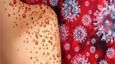 الصحة العالمية: جدري القرود ليس مثل وباء كورونا