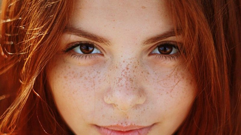 رؤية النمش في المنام