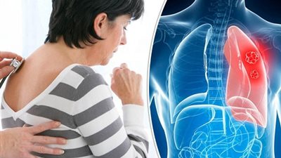 في اليوم العالمي للرئتين.. الصحة تكشف 7 أعراض تنبأ بـ سرطان الرئة