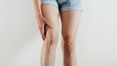 لو بتعاني من دوالى الساقين.. تعرفي على أهم الأسباب والأعراض للإصابة به