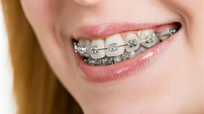 إليك أفضل النصائح للحفاظ على تقويم أسنانك