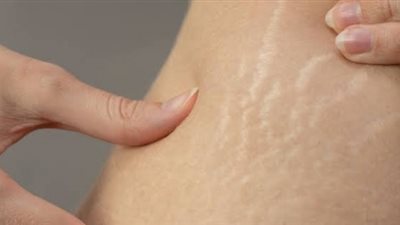 زيوت عطرية ساحرة للتخلص من علامات تمدد البشرة