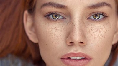  وصفات طبيعية ساحرة لإزالة النمش من الوجه