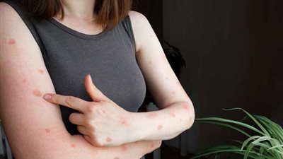 الأفريقي لمكافحة الأوبئة يحذر: جدري القردة خرج عن السيطرة