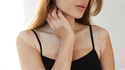 تفسير حلم مرض البهاق في المنام للعزباء والمتزوجة والحامل