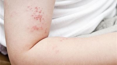 أعراض الإصابة بالحزام الناري.. وما هي مضاعفاته ومراحل الإصابة به