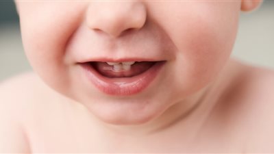 القومي للبحوث يوضح أسباب تسوس الأسنان عند الأطفال