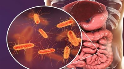 بكتيريا إي كولاي.. ما أسباب الإصابة بالإشريكية القولونية وطرق علاجها؟