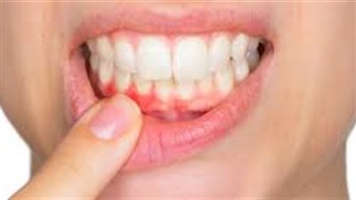 «واظبي عليها».. 8 نصائح هامة لتجنب الإصابة بنزيف اللثة