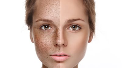 قناع طبيعي يحميك من ظهور النمش بكثرة 