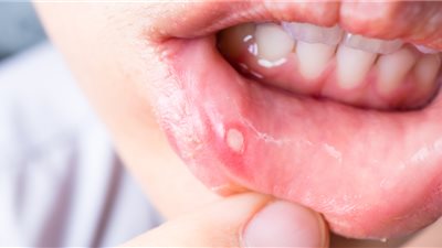 لتخفيف آلام قرحة الفم.. إليك هذه الوصفة 