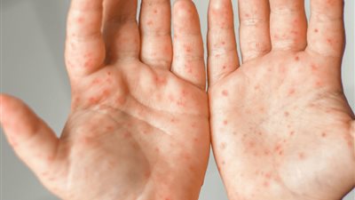 عدوى فيروسية.. هيئة الدواء توضح أعراض مرض «اليد والقدم والفم» المنتشر 