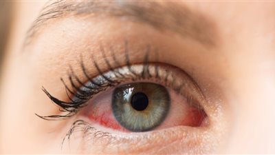 الصحة توضح سبب إصابة العين بالجفاف في فصل الشتاء وكيف تحافظي على سلامتها؟