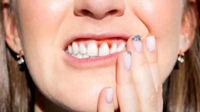 بعد ظهوره في فرنسا.. ماذا تعرف عن مرض الإسقربوط؟