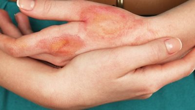 احذريها.. لا تفعلي هذه الخطوة عند التعرض للحروق