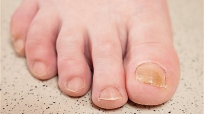 مرض نادر.. أسباب وأعراض متلازمة الأظافر الصفراء وطرق العلاج