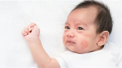 أستاذة بالقومي للبحوث يحذر الأمهات من حساسية الألبان لدي الرضع