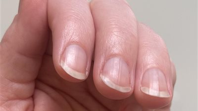 5 أسباب للإصابة بتجاعيد الأظافر و4 طرق لعلاجها