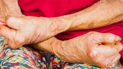 هيئة الدواء تكشف 4 نصائح مهمة لمرضى الجذام