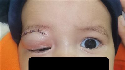 «طب وجراحة العيون» بمستشفى سوهاج الجامعي ينجح في إنقاذ عين رضيعة