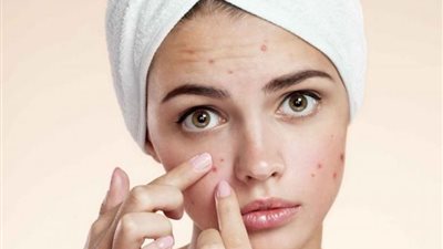 استعدي للعيد.. وصفات طبيعية فعالة للتخلص من حب الشباب