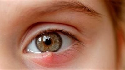 تعرفي إزاي إن طفلك عنده رمد ربيعي وتعملي إيه؟.. وزارة الصحة توضح 