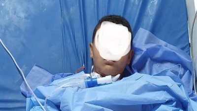 بالصور.. مستشفى سوهاج الجامعى تنقذ حياة طفل بعد اختراق سيخ معدنى للرقبة والفك