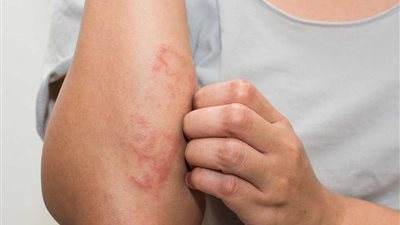 مع حر الصيف.. تعملي إية في حالة الإصابة بحمو النيل؟ 