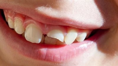 تفسير رؤية الأسنان المكسورة في المنام  لابن سيرين 