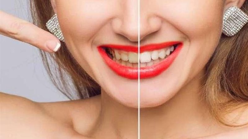 اصفرار الأسنان