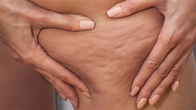  زيوت طبيعية فعالة  للتخلص من السيلوليت وطرق إستخدامها 