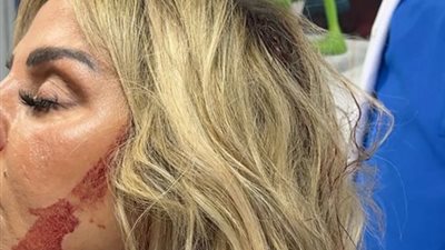 رزان مغربي توجه رسالة بعد إصابتها في سقوط سقف فندق بالجيزة