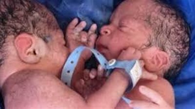 حالة ولادة نادرة لتوأم ملتصق في الزقازيق