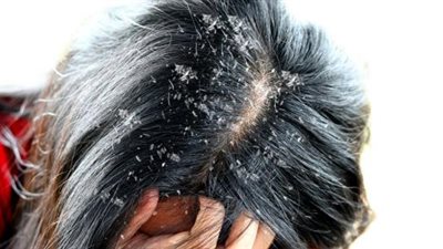 أزمات مالية.. تفسير حلم القشرة  في الشعر للعزباء والمتزوجة