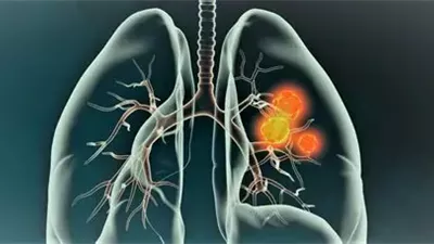 7 أعراض لسرطان الرئة من بينها التعب وفقدان الوزن لأسباب غير معروفة  