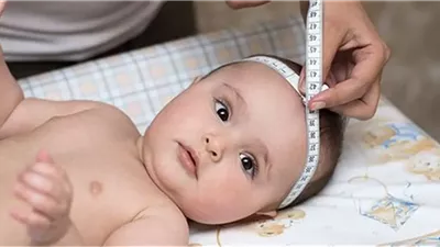 تعرفي على مرض الاستسقاء الدماغي وخطورة إهماله