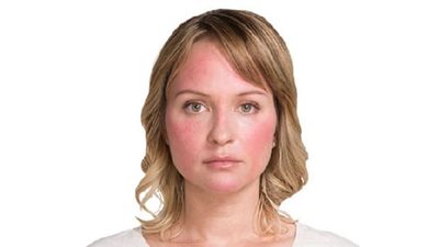 10 أسباب للإحمرار المتكرر بالوجه.. ما هي؟ 