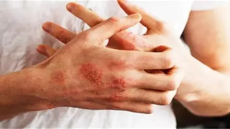 مرض الصدفية 