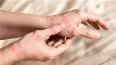 الشتاء والبشرة.. نصائح للتعامل مع تفاقم الأكزيما والصدفية