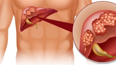 دراسة: تقليل البروتين يبطئ سرطان الكبد